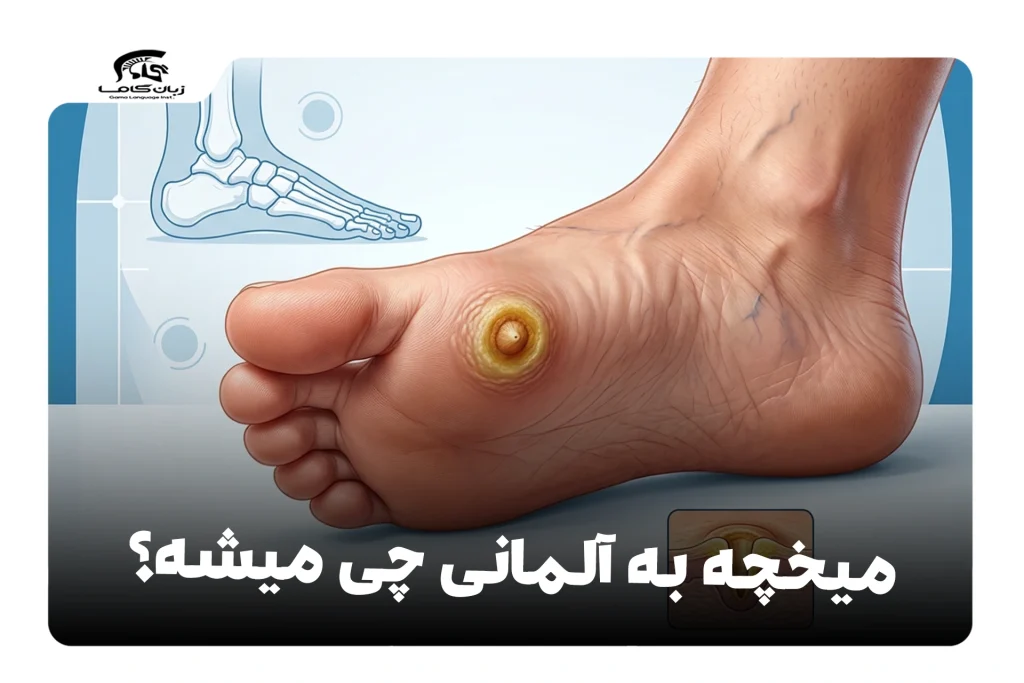میخچه به آلمانی